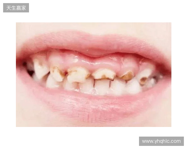 韦林顿确诊上唇部贯通伤;11、21牙半脱位;上颌前牙区牙槽骨骨折 韦林顿确诊上唇部贯通伤;11、21牙半脱位;上颌前牙区牙槽骨骨折